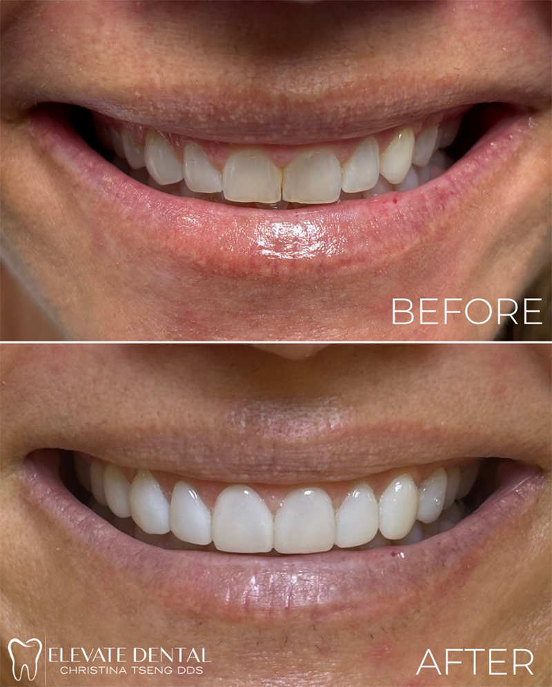 Elevate Dental | Periodontal Treatment, Implant Dentistry and Dermal Fillers