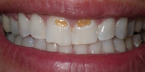 close up picture of a patient's teeth before their treatment