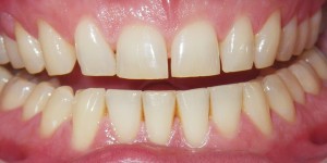 close up picture of a patient's teeth