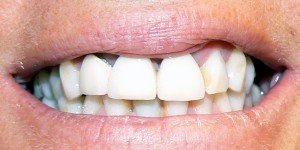 picture of a patient's teeth