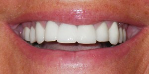 close up picture of a patient's smile after their makeover