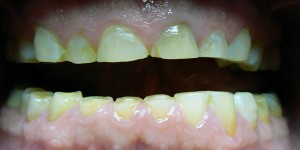 close up of a patient's teeth before their treatment
