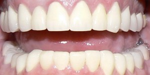 close up picture of a patient's teeth