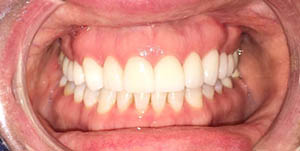 picture of a patient's smile after their treatment