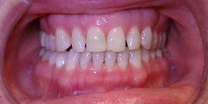 picture of a patient's mouth before their makeover