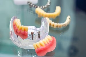 prosthetic teeth with mini dental implants