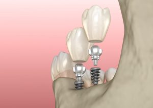 mini dental implant