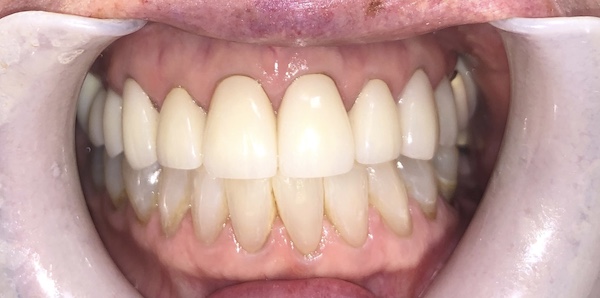 close up of dental work on teeth after treatment