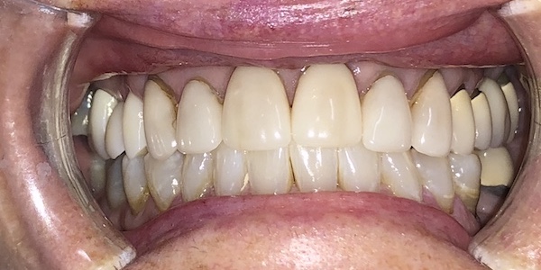 close up on teeth receiving treatment