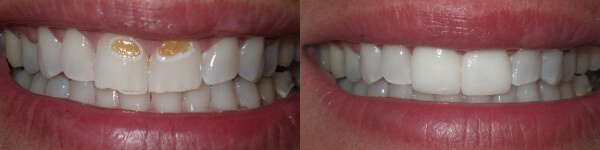 before and after images of dental work on upper front teeth