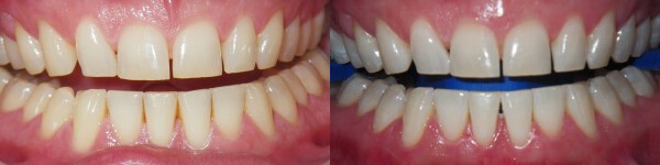 before and after images of teeth whitening work