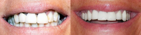 before and after images of patient's upper front dental work