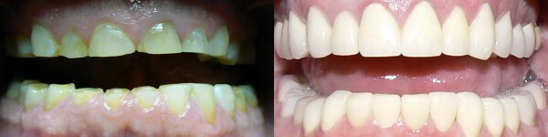 before and after images of patient receiving new set of teeth
