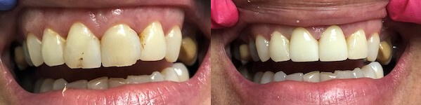 before and after images of filling a patient's upper front chipped teeth
