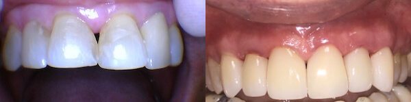 before and after images of filling in gaps of patient's front teeth