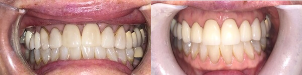 before and after images side by side of patient's dental work