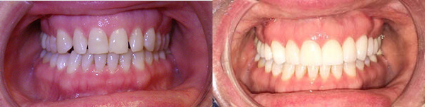 Gaffney's before and after images of dental work